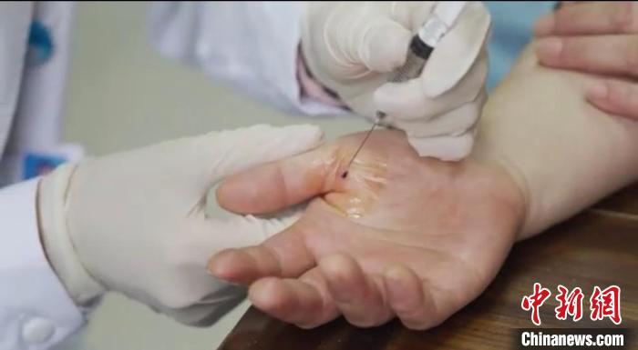 嘉善群眾體驗小針刀。　嘉善統(tǒng)戰(zhàn) 供圖