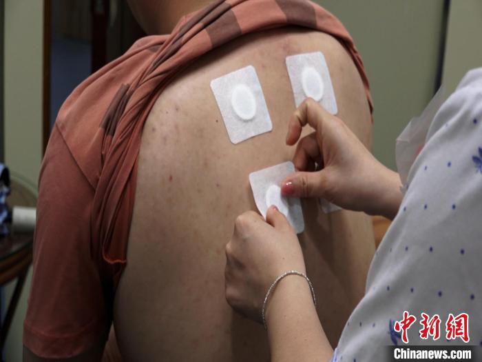 圖為醫(yī)生正在為民眾貼“三伏貼”?！√莆登?攝